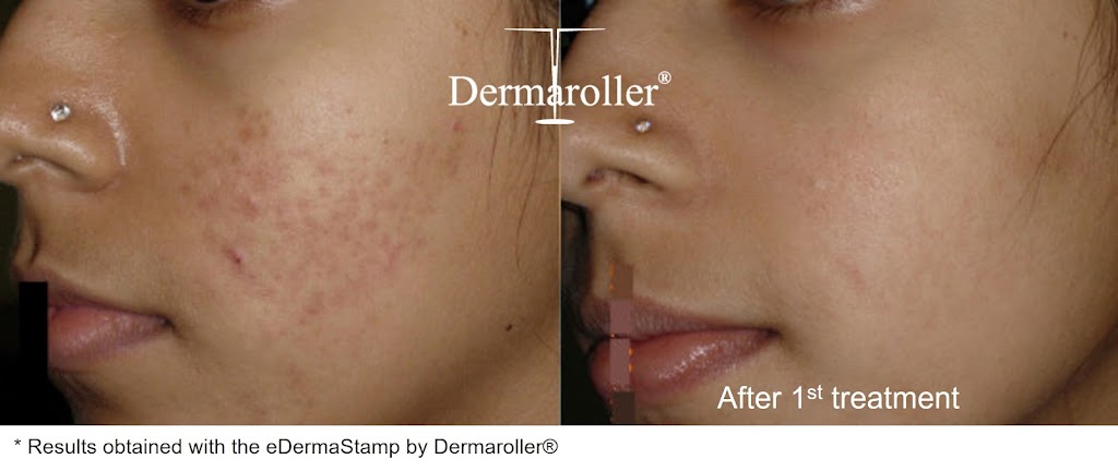 Esthétique Euro laser - Soin du visage Saint Laurent | 3500 Boulevard Cote Vertu Ouest Suite 130, Saint-Laurent, QC H4R 1P8, Canada | Phone: (514) 823-5292