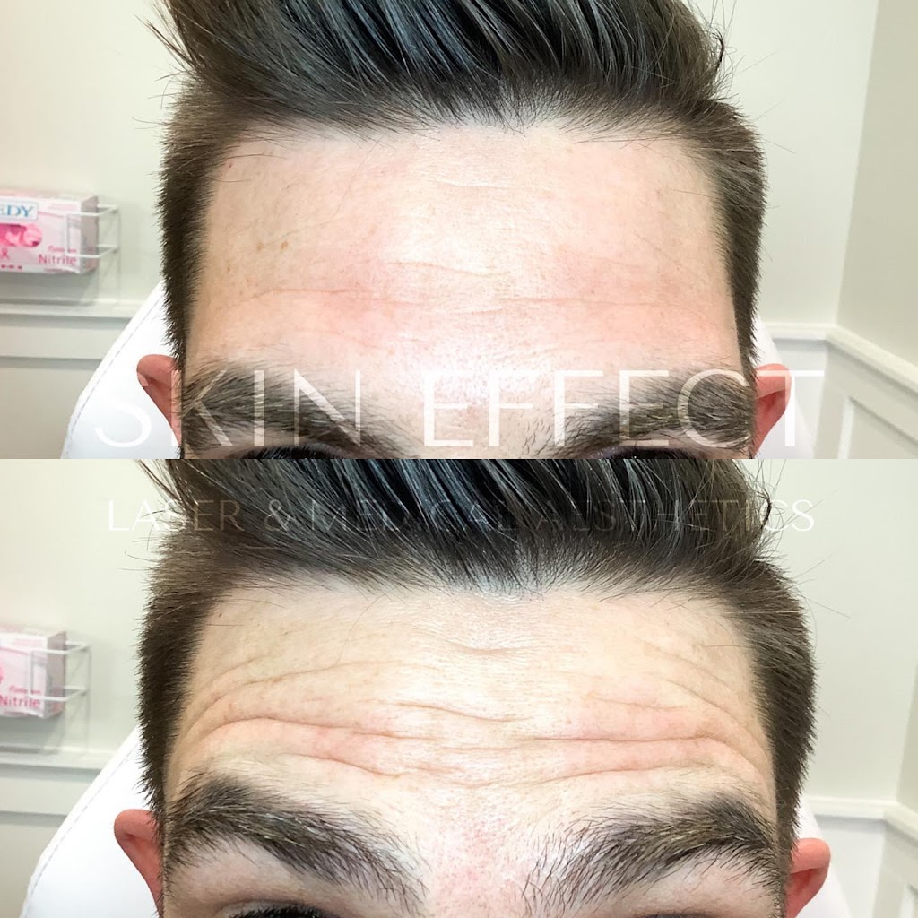 Skin Effect Laser and Medical Aesthetics | 10441 99 Ave Unit 701, Fort Saskatchewan, AB T8L 0V6, Canada | Phone: (780) 935-7546