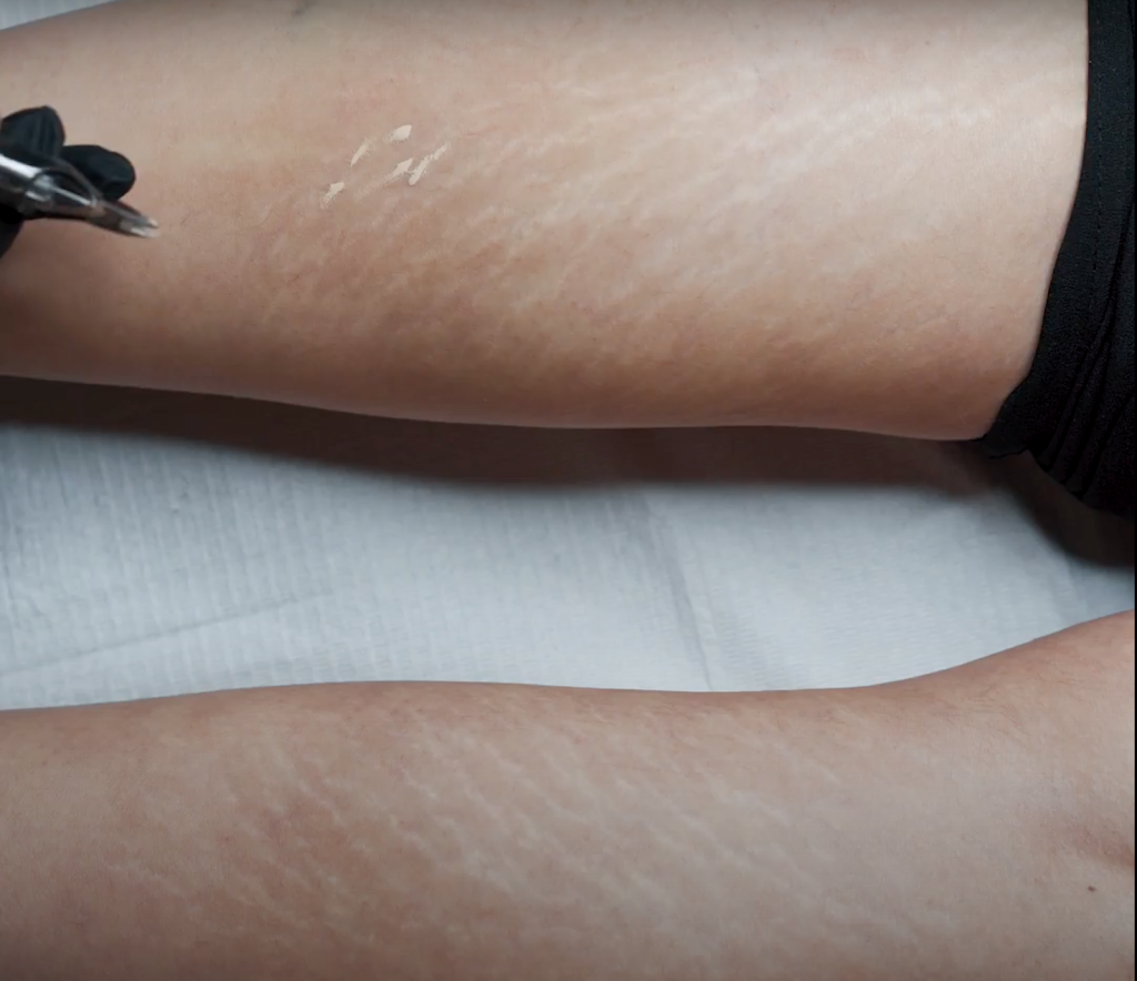 Dariana Garcia Calgary - Stretch Mark and Scar Camouflage | 46 Haddock Rd SW, Calgary, AB T2V 3J8, Canada | Phone: (403) 714-3471