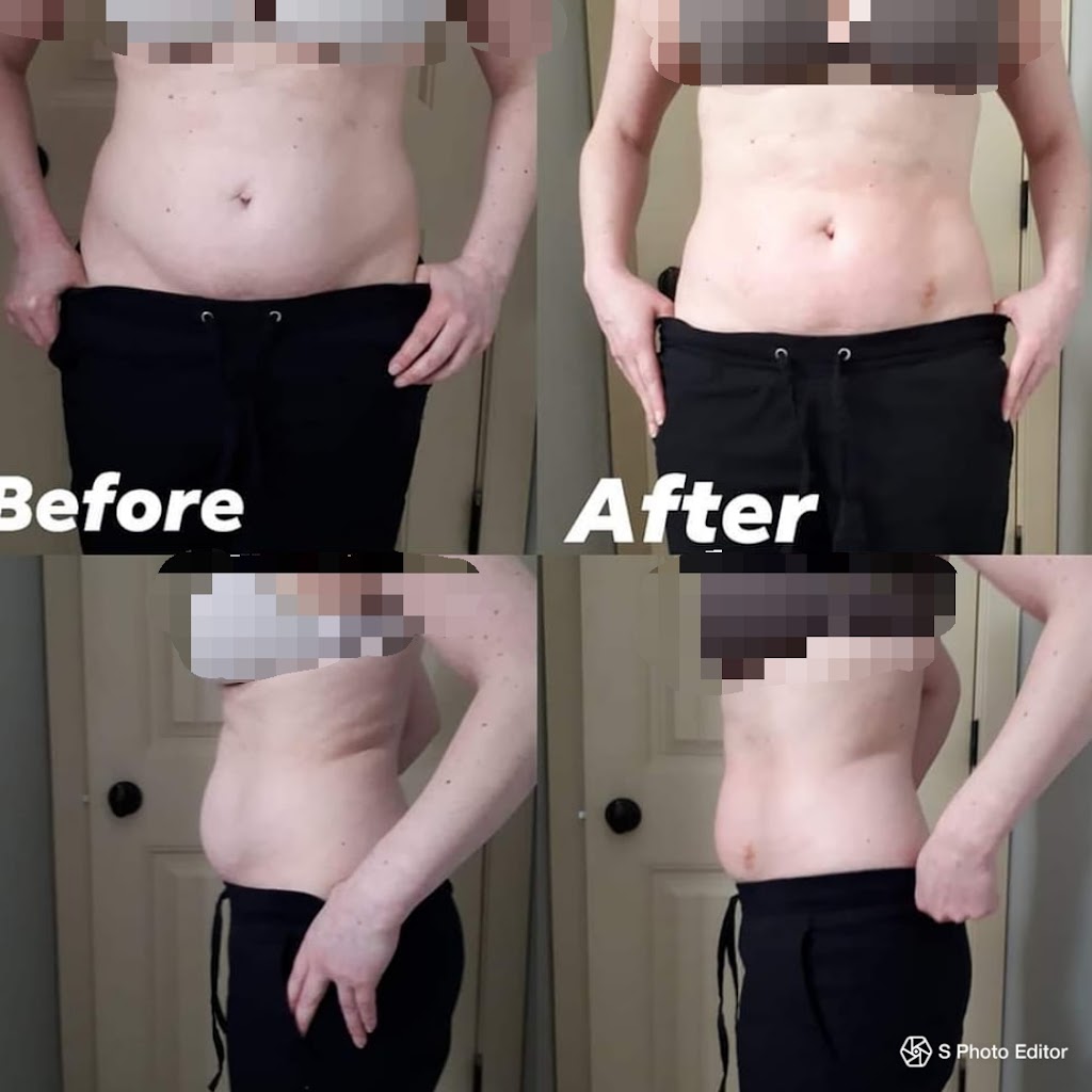 Valencia Body Contouring Inc. | 147 Bridlecrest St SW, Calgary, AB T2Y 5J1, Canada | Phone: (403) 473-4622