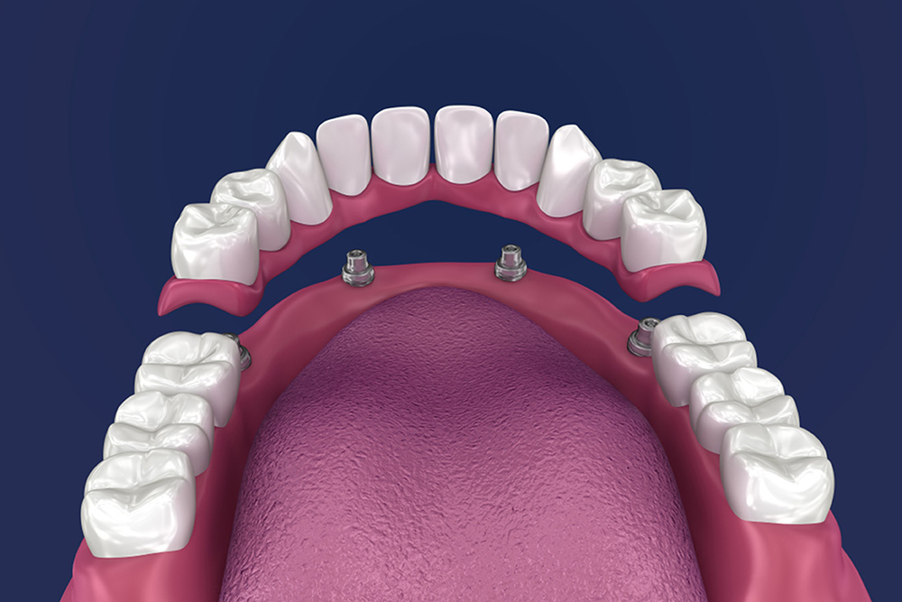 Keele Crosstown Dental | 2563 Eglinton Ave W, York, ON M6M 1T3, Canada | Phone: (416) 656-1170