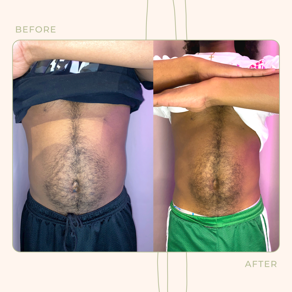 Snatched by Ale Fat Freezing | 59 Cathedral High St Unit 1, Markham, ON L6C 0P1, Canada | Phone: (647) 806-5353