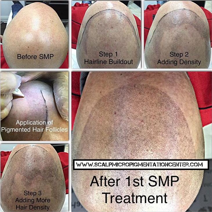 Scalp Micropigmentation London | 328 Glenrose Dr, London, ON N6K 2A8, Canada | Phone: (519) 881-6044