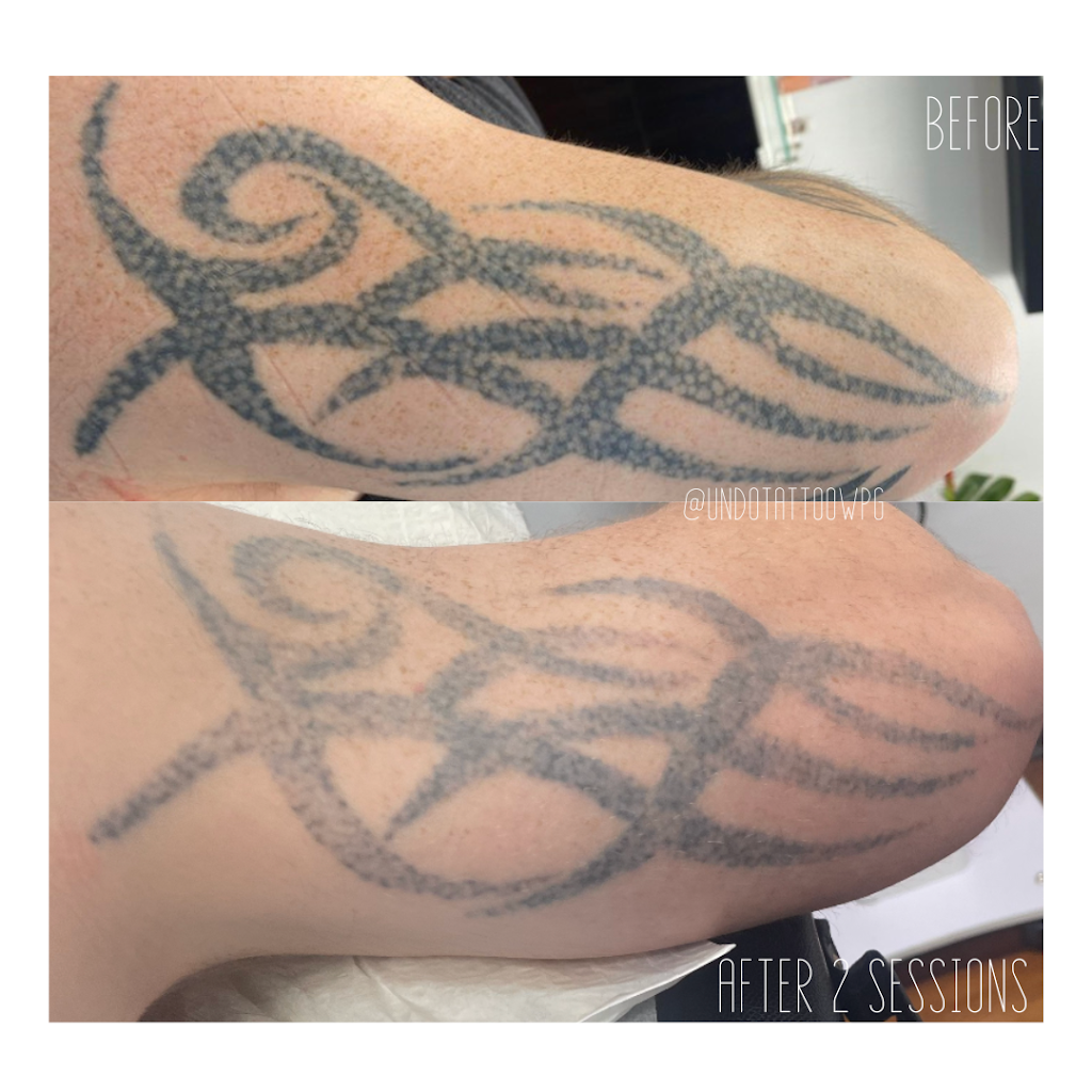 Undo Tattoo Laser Tattoo Removal | 169 Marion St, Winnipeg, MB R2H 0T3, Canada | Phone: (204) 558-8636