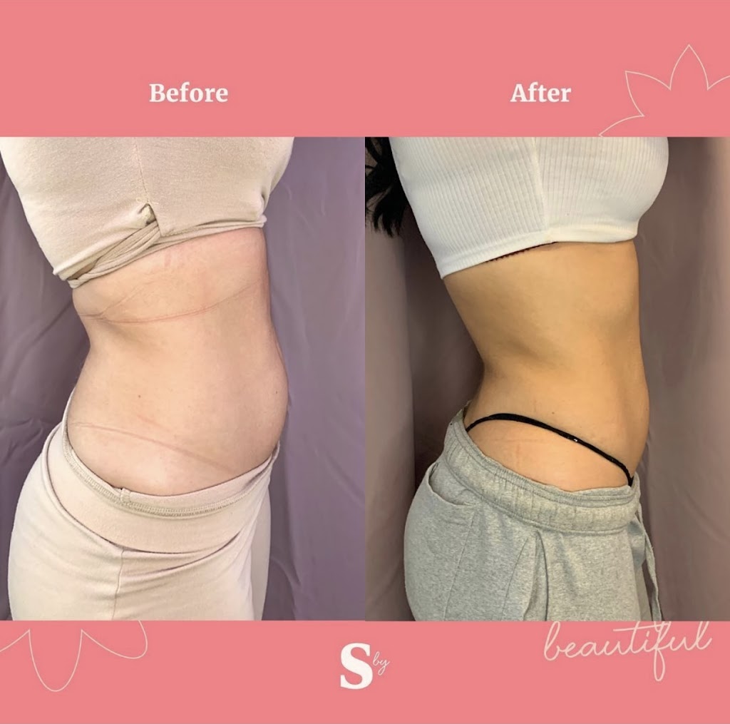 Snatched by Ale Fat Freezing | 59 Cathedral High St Unit 1, Markham, ON L6C 0P1, Canada | Phone: (647) 806-5353