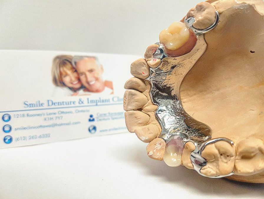 Smile Denture & Implant Clinic | 1825 Woodward Dr, Ottawa, ON K2C 0P9, Canada | Phone: (613) 702-2656