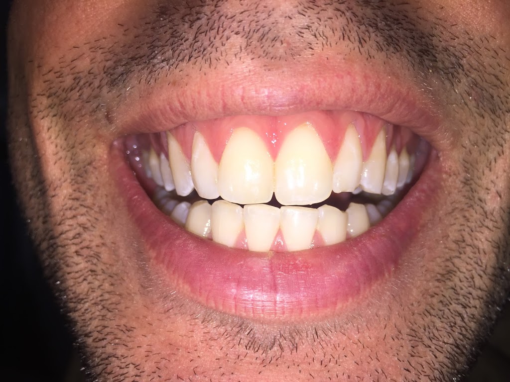 THE WHITEST SMILES Professional Teeth Whitening Centre | 251 Fanshawe Park Rd W #200, London, ON N6G 0E1, Canada | Phone: (877) 476-4534