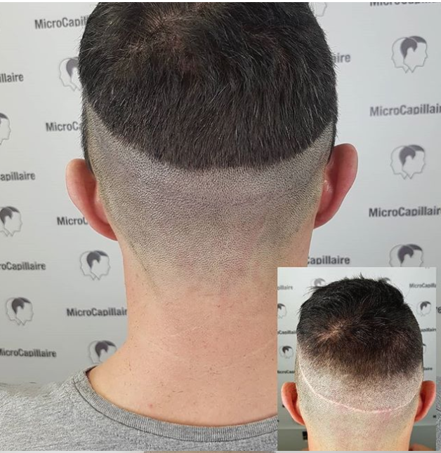 Clinique MicroCapillaire - Scalp Micropigmentation Capillaire | 2884 Chemin de Chambly, Longueuil, QC J4L 1G7, Canada | Phone: (450) 679-1888