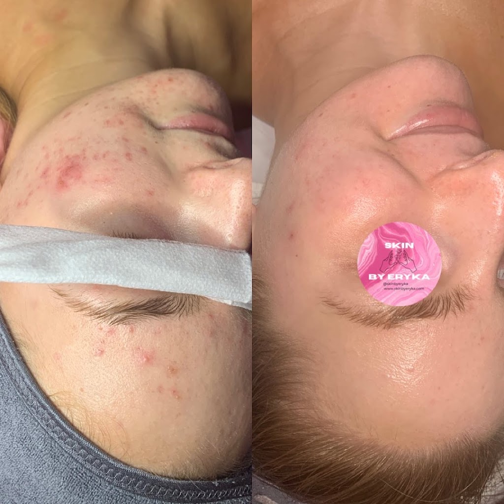 Clinique Skin by Eryka | 9 Avenue de la Baie-de-la, Av. de la Baie de Valois suite 3, Pointe-Claire, QC H9S 5H2, Canada | Phone: (514) 577-0605