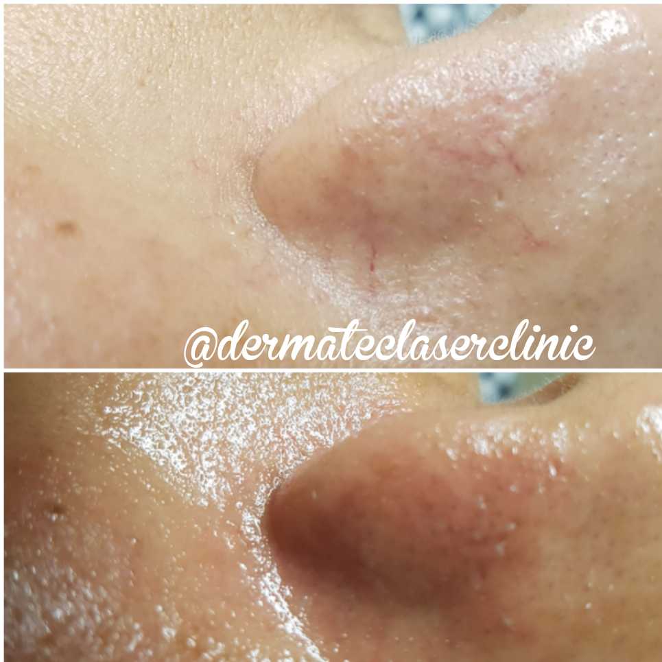 Dermatec Permanent Cosmetic and Laser Clinic | 6499 122a St, Surrey, BC V3W 3R8, Canada | Phone: (604) 805-4273