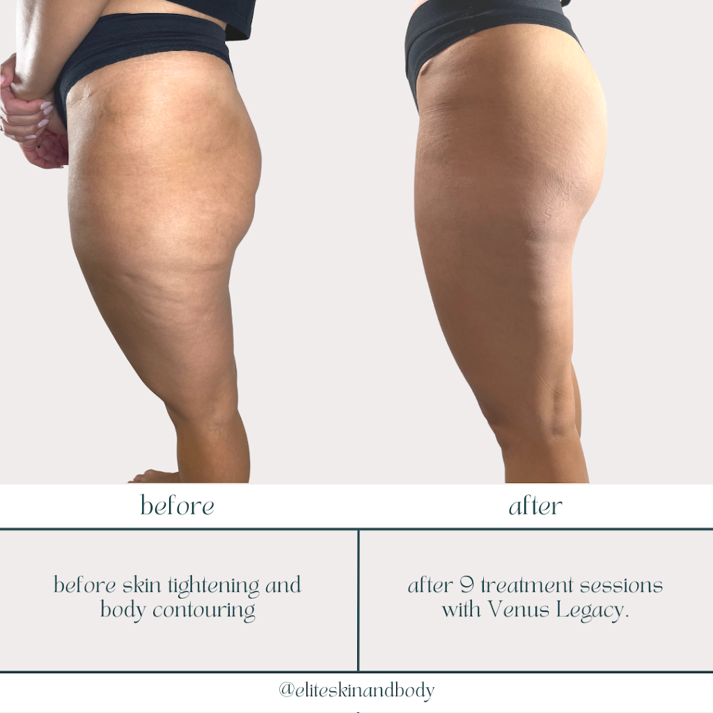 Elite Skin & Body | 59 Mellings Dr, Woodbridge, ON L4L 8J2, Canada | Phone: (416) 554-3117
