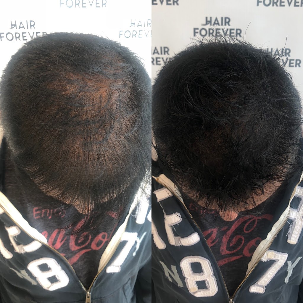 Hair Forever | hair care | 2250 Bovaird Dr E #608, Brampton, ON L6R 2T3, Canada | 9054978555 OR +1 905-497-8555