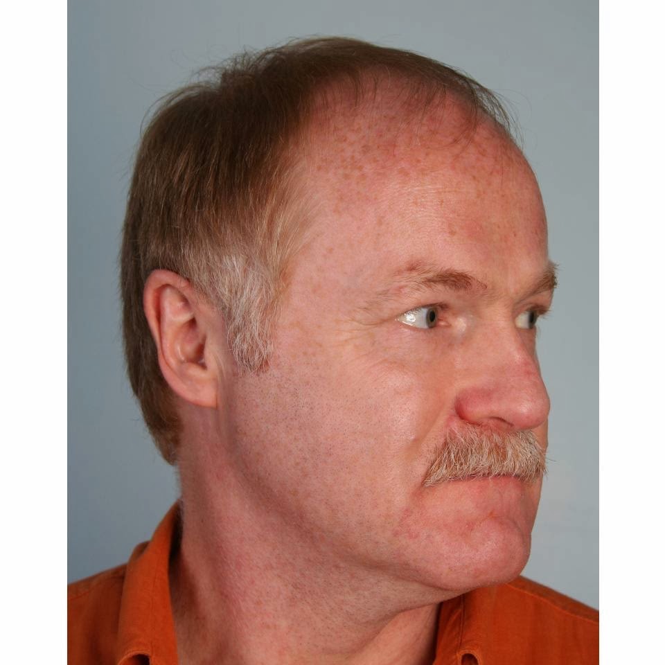 Canadian Hair Transplant Centre | 2863 Ellesmere Rd Suite #405, Scarborough, ON M1E 4B9, Canada | Phone: (416) 924-2482