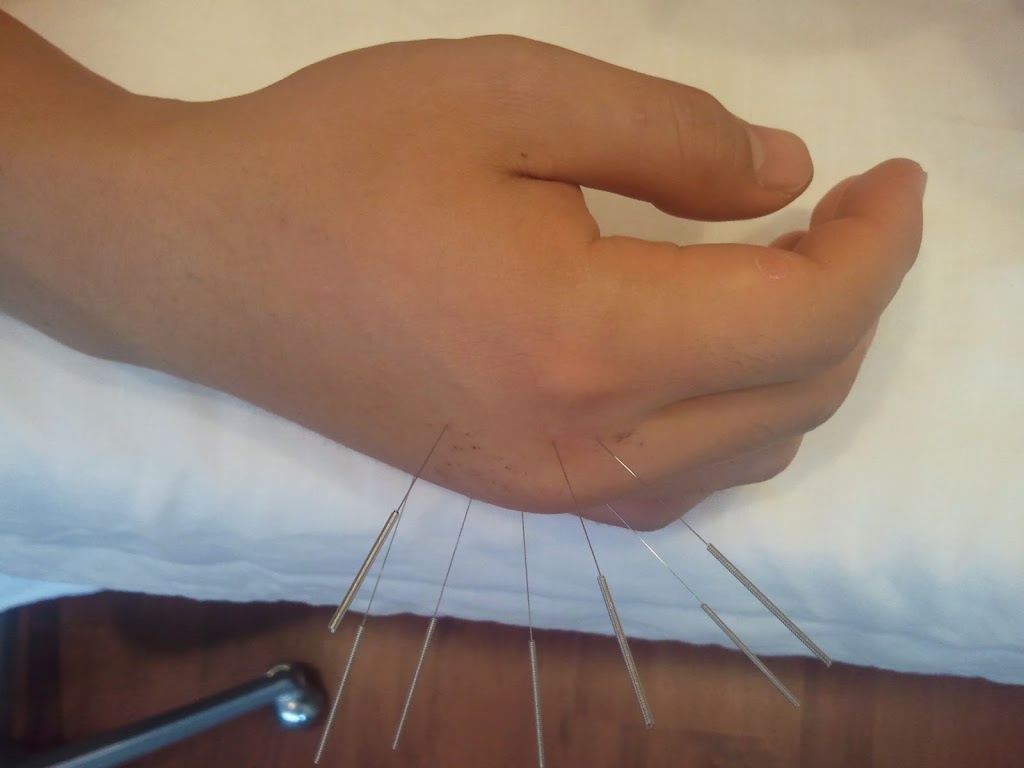 Gloria Wellness and Acupuncture Clinic | 102-1061 Ridgeway Ave, Coquitlam, BC V3J 1S6, Canada | Phone: (604) 671-1007