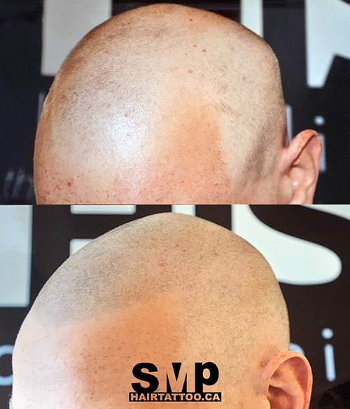 SMP® Scalp Micropigmentation Richmond Hill | HAIRTATTOO.CA | 9140 Leslie St #301, Richmond Hill, ON L4B 3L6, Canada | Phone: (647) 492-9093