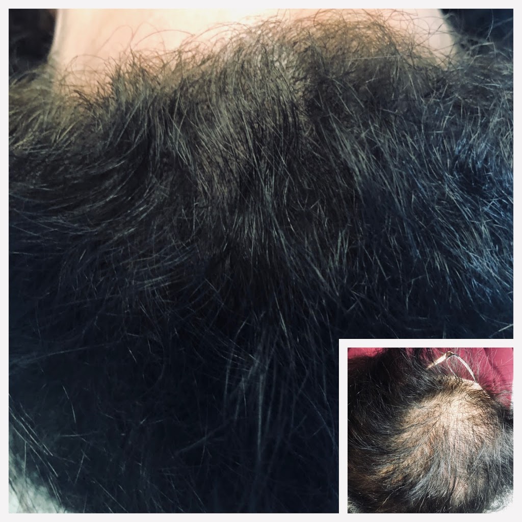 Royal Scalp and Brows - Scalp Micropigmentation and Microblading | 22366 Dewdney Trunk Rd, Maple Ridge, BC V2X 3J2, Canada | Phone: (778) 888-1557