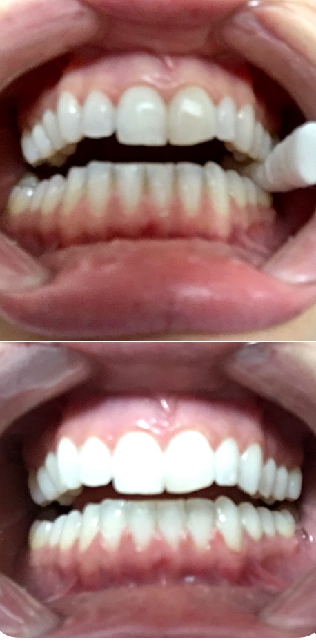 Sensational Smile Whitening | 16748 61 St NW, Edmonton, AB T5Y 0W7, Canada | Phone: (780) 221-6240