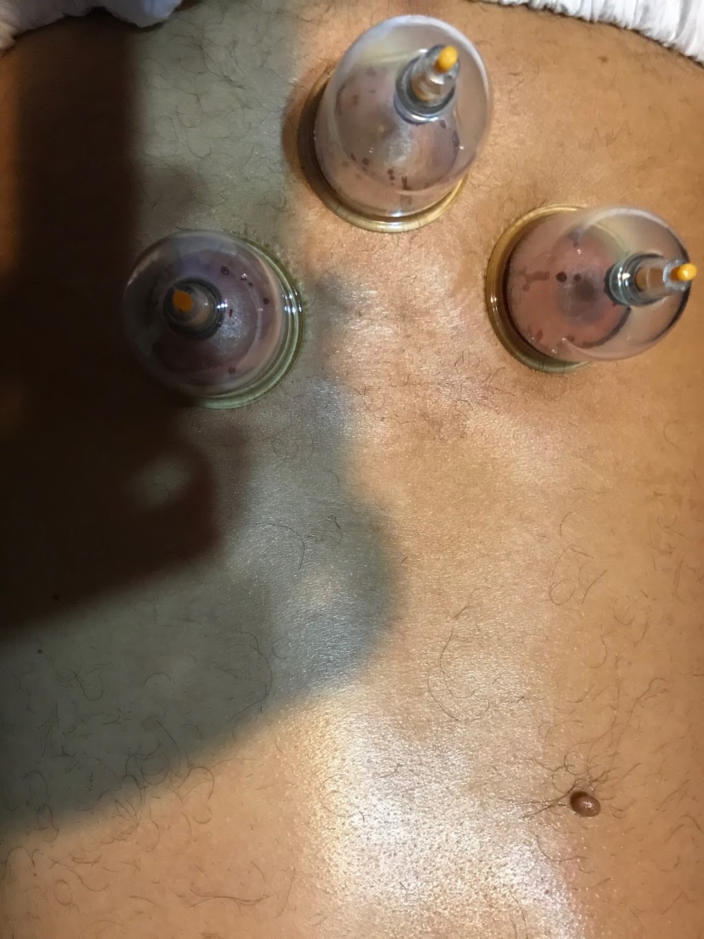 Holistic Hijama Benefits | 3915 Baggins Ct, Mississauga, ON L5N 7A3, Canada | Phone: (416) 388-5036