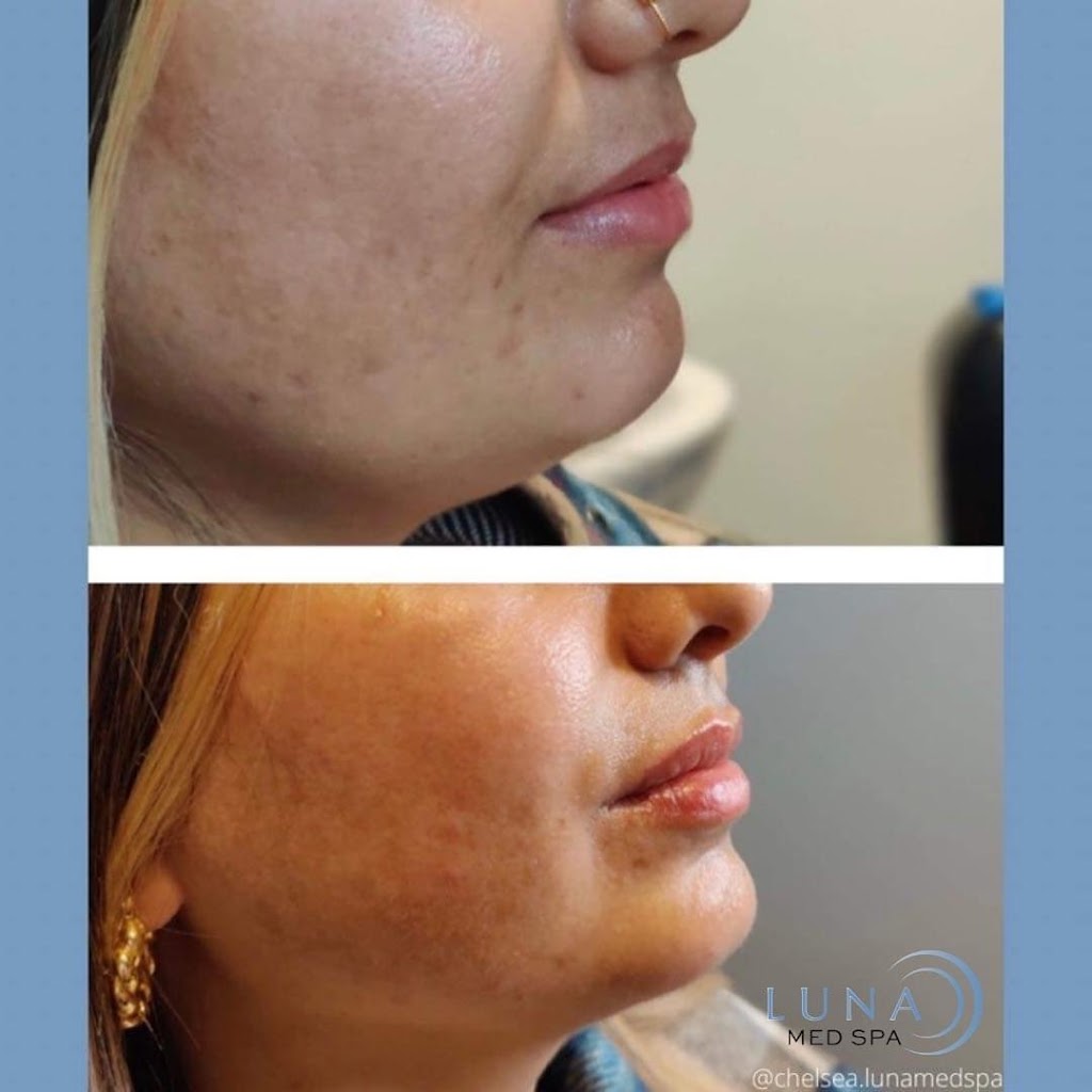 Luna Med Spa | RCI & MedSpa Group, 5045 Mainway Suite 201, Burlington, ON L7L 5Z1, Canada | Phone: (905) 981-8454