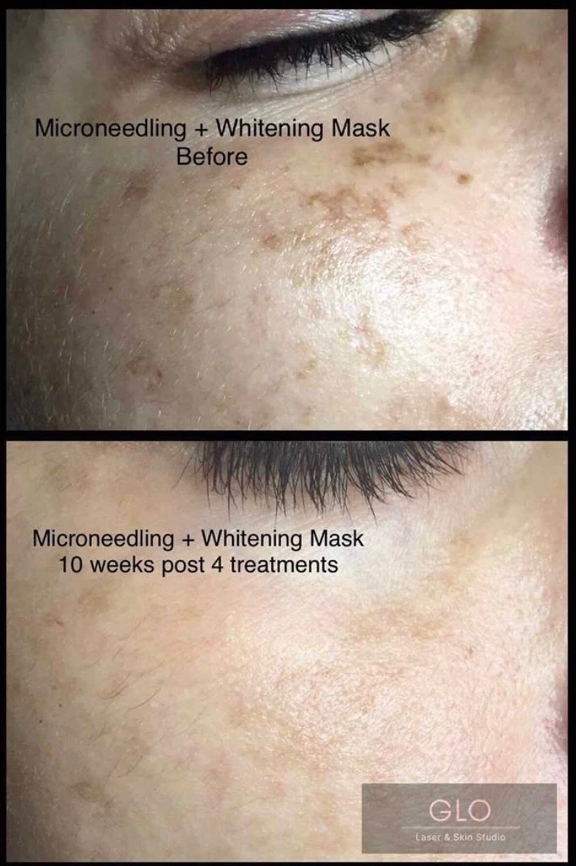 GLO Laser & Skin Studio | 7500 York Regional Rd 27 Unit 26, Vaughan, ON L4H 0J2, Canada | Phone: (905) 605-4566