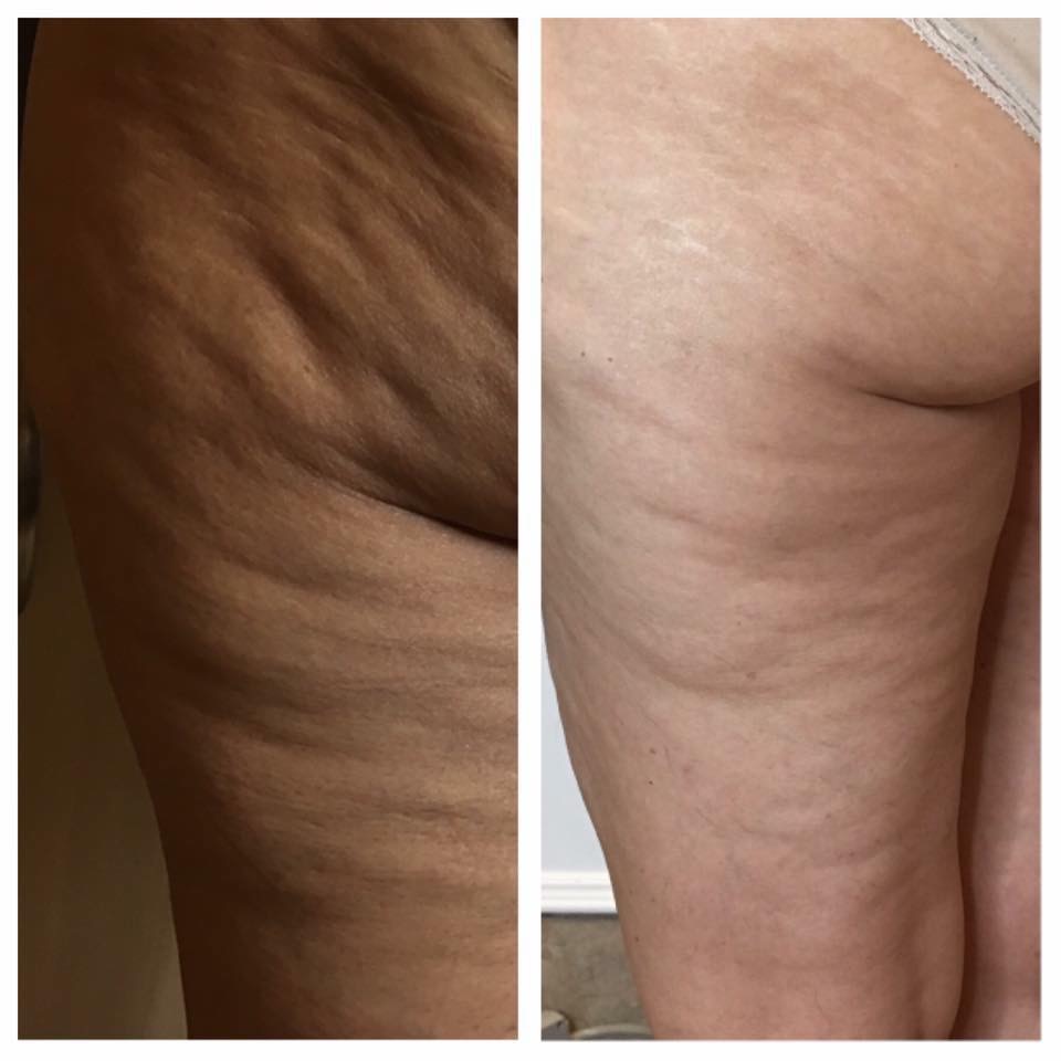 Clinique Medispa | 201 Rue Champlain Local 202, Bromont, QC J2L 3B2, Canada | Phone: (450) 726-9050