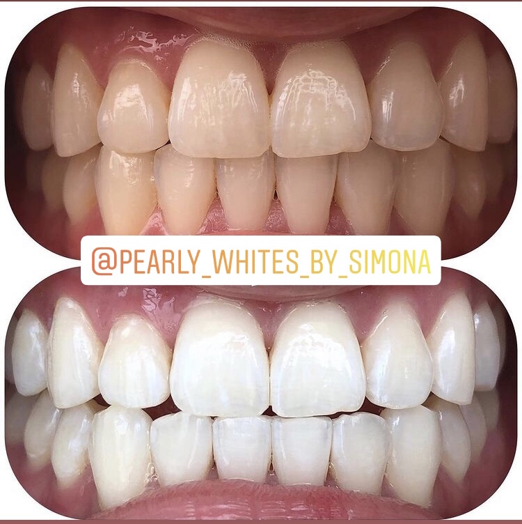 Pearly Whites by Simona | Hwy 7, Weston Rd, Vaughan, ON L4L 9H1, Canada | Phone: (416) 830-6966
