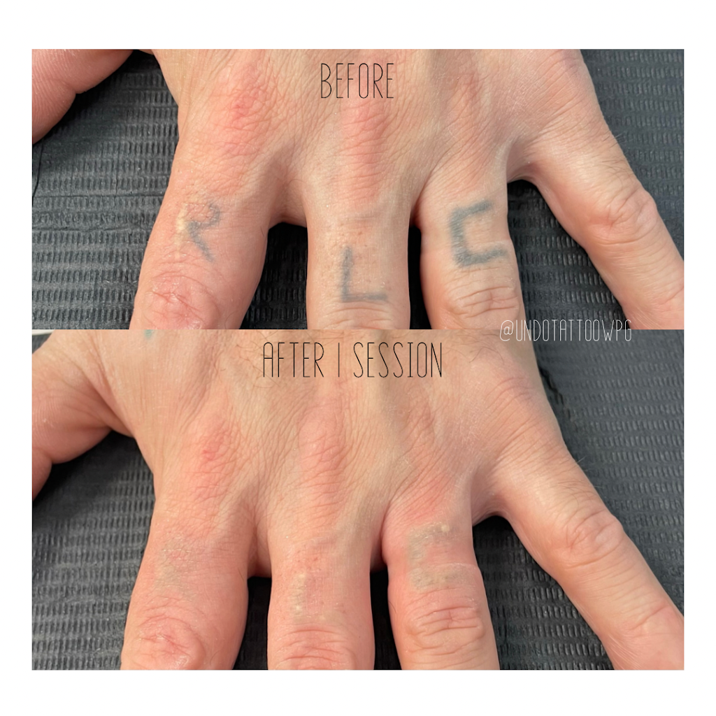 Undo Tattoo Laser Tattoo Removal | 169 Marion St, Winnipeg, MB R2H 0T3, Canada | Phone: (204) 558-8636