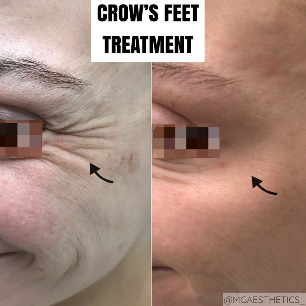 MG AESTHETICS | 10395 Weston Rd, Woodbridge, ON L4H 3T4, Canada | Phone: (289) 380-7774