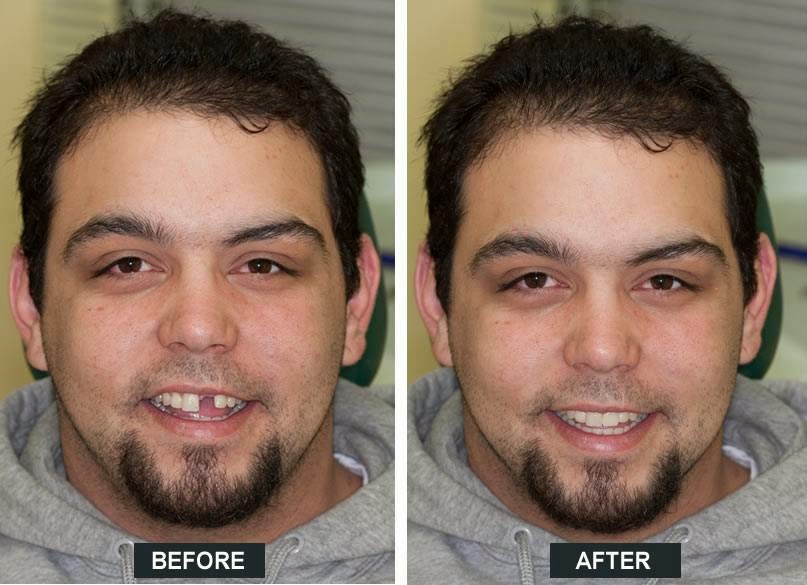 Bracebridge Denture Clinic | Archdekin Medical Building, 205 Hiram St, Bracebridge, ON P1L 2C1, Canada | Phone: (705) 646-0504
