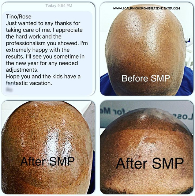 Scalp Micropigmentation Training Center Head Office | 19 Aerodrome Crescent #301, East York, ON M4G 4J3, Canada | Phone: (844) 877-2257