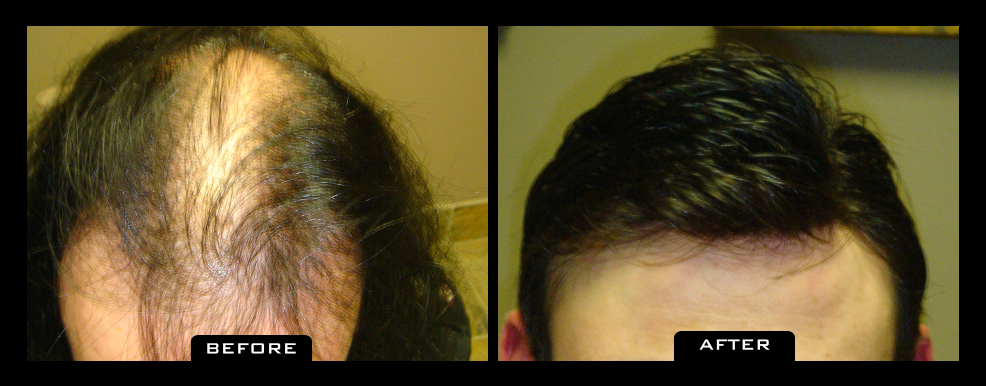 NuHair Medical Hair Transplant Centre | 5526 111 St NW, Edmonton, AB T6H 3E9, Canada | Phone: (587) 400-0344