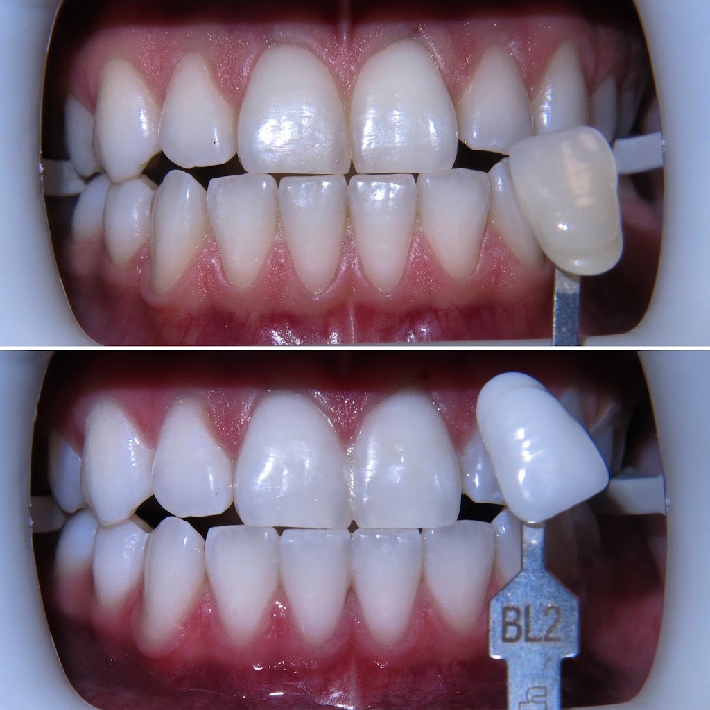 Dr Arun Narang & Associates Smile by Design | dentist | 3038 Hurontario St #4, Mississauga, ON L5B 3B9, Canada | 9058971166 OR +1 905-897-1166