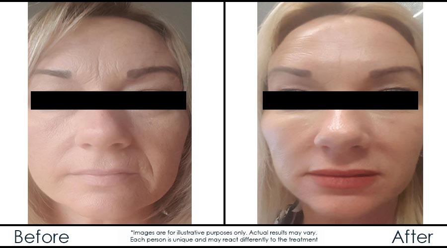 Infinium Médecine Esthétique | 729 Boulevard Saint-Joseph, Gatineau, QC J8Y 4B6, Canada | Phone: (819) 771-4284