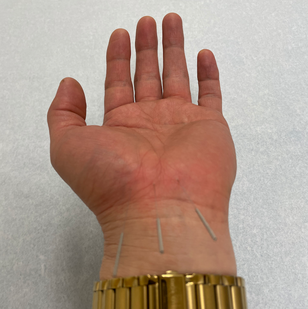 Acupuncture in Hamptons | 10109 Hamptons Blvd NW, Calgary, AB T3A 5A8, Canada | Phone: (403) 993-3202