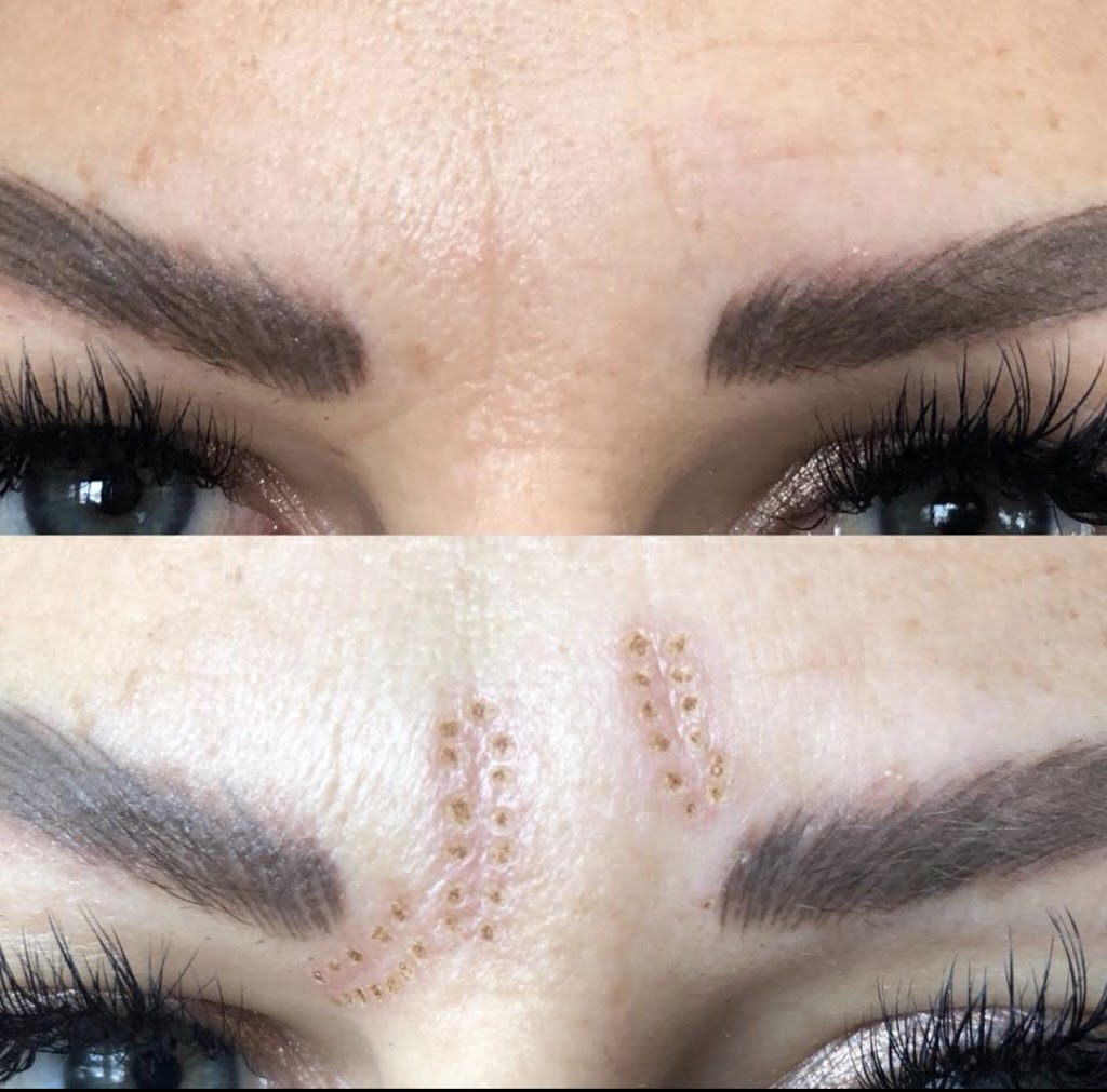 Plasma Skin Regeneration | 00 Ranch Gate, Strathmore, AB T1P 0B4, Canada | Phone: (403) 901-4663