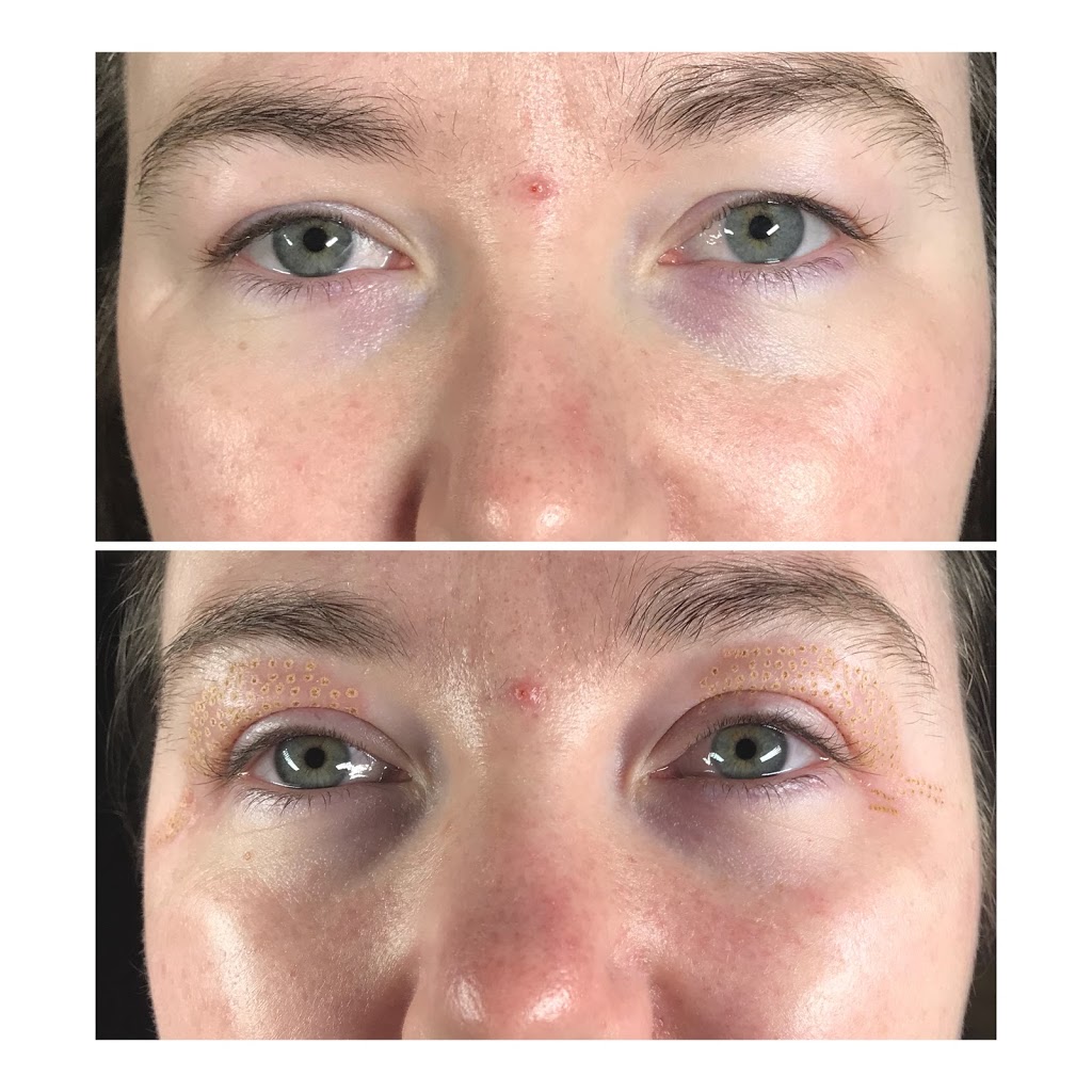 Plasma Skin Regeneration | 00 Ranch Gate, Strathmore, AB T1P 0B4, Canada | Phone: (403) 901-4663