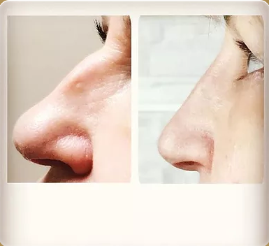 Bella Vita Injectables | 1169 Garner Rd E, Ancaster, ON L9G 3K9, Canada | Phone: (905) 327-2478