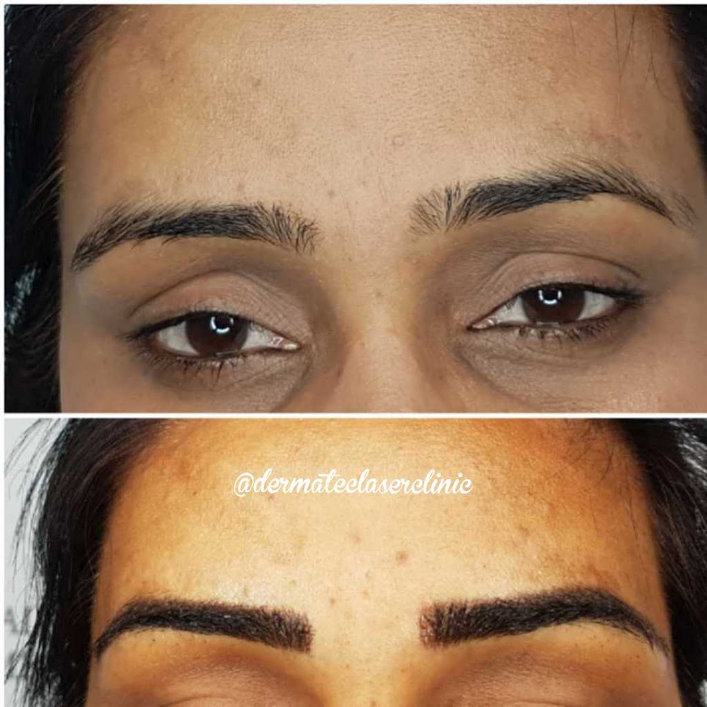 Dermatec Permanent Cosmetic and Laser Clinic | 6499 122a St, Surrey, BC V3W 3R8, Canada | Phone: (604) 805-4273