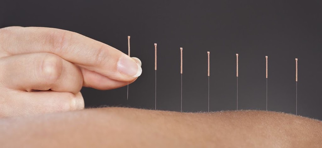 Acupuncture Isabelle Dufresne - Sherbrooke | 1871 Rue Galt O, Sherbrooke, QC J1K 1J5, Canada | Phone: (819) 943-9897