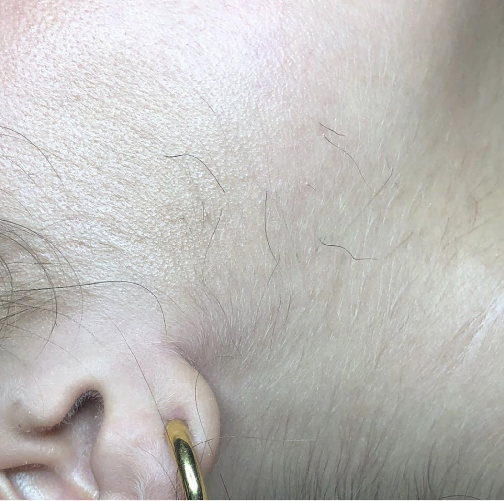 Emoveo Electrolysis | 36 Rue Montalet, Beaumont, AB T4X 0G1, Canada | Phone: (780) 238-9987