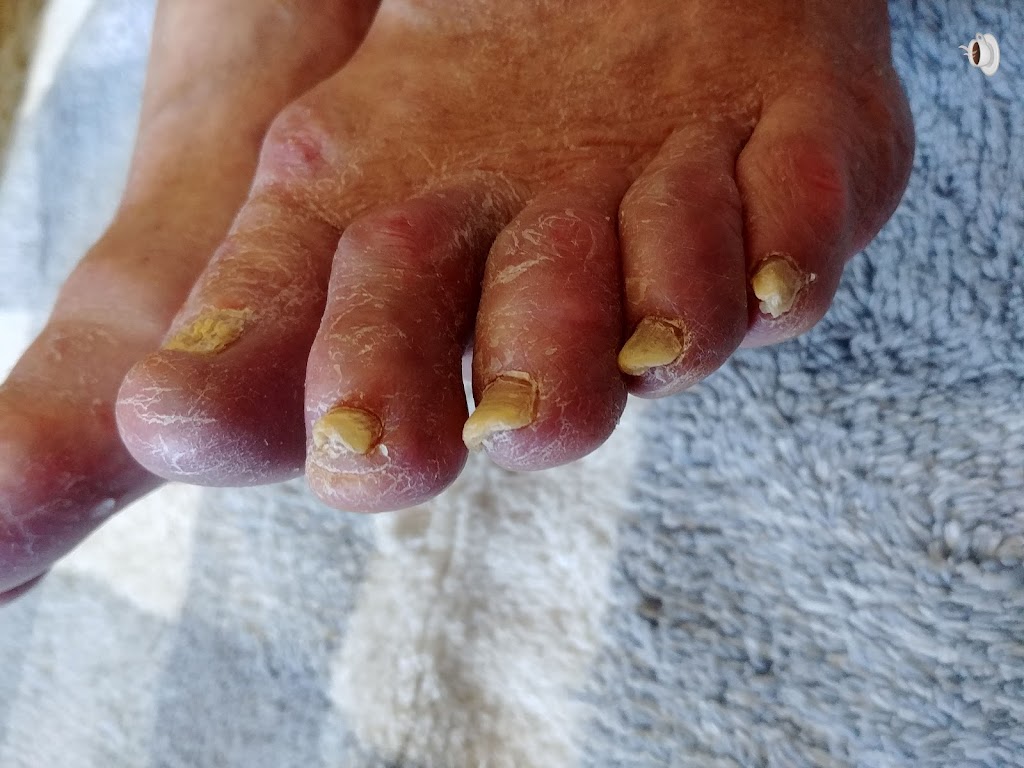 Healthy Feet Mobile Foot Care Services | Gough Ave, London, ON N5X 4P8, Canada | Phone: (519) 933-9155