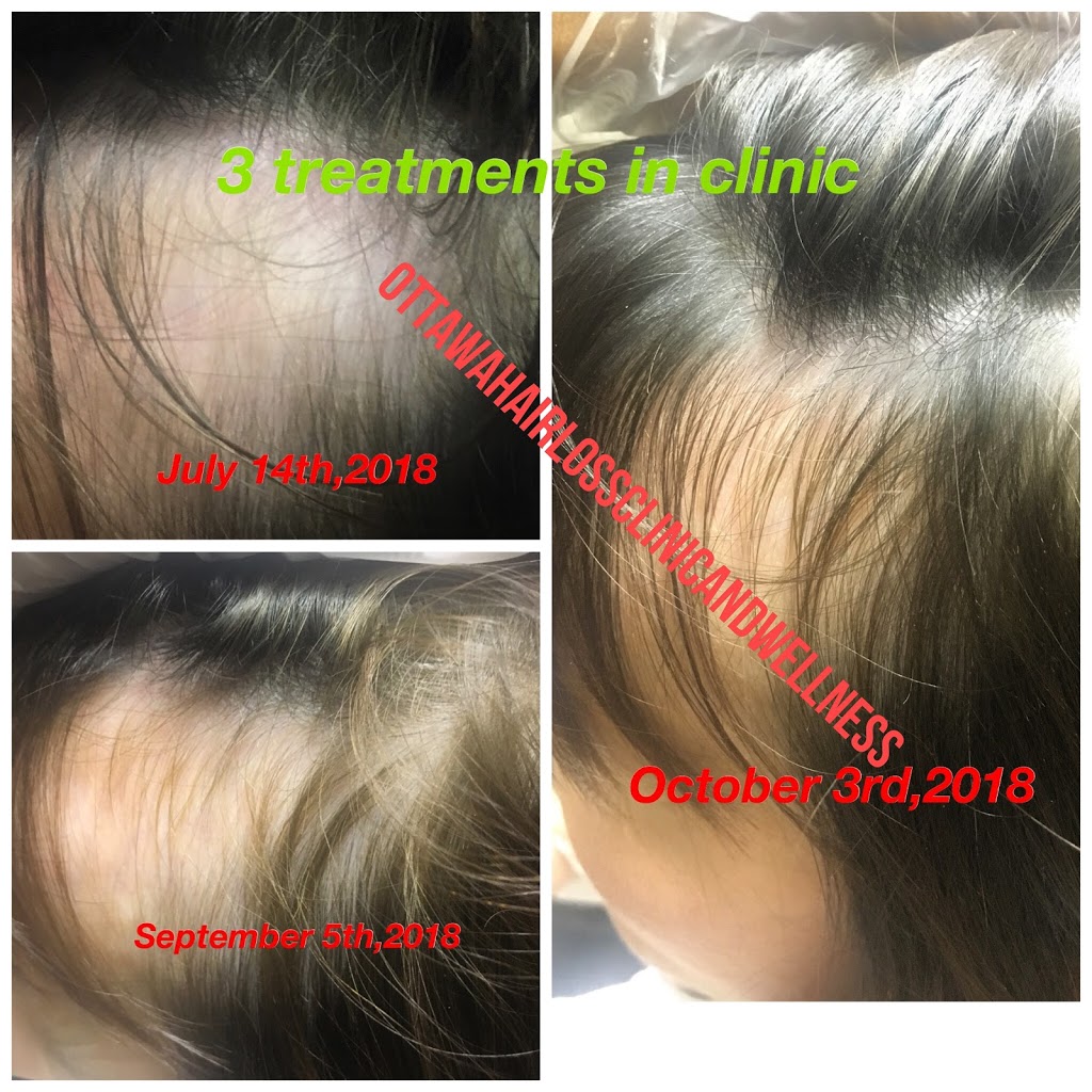 Ottawa Hair Loss Clinic & Wellness | 2888 St Joseph Blvd, Orléans, ON K1C 1G7, Canada | Phone: (613) 837-4656