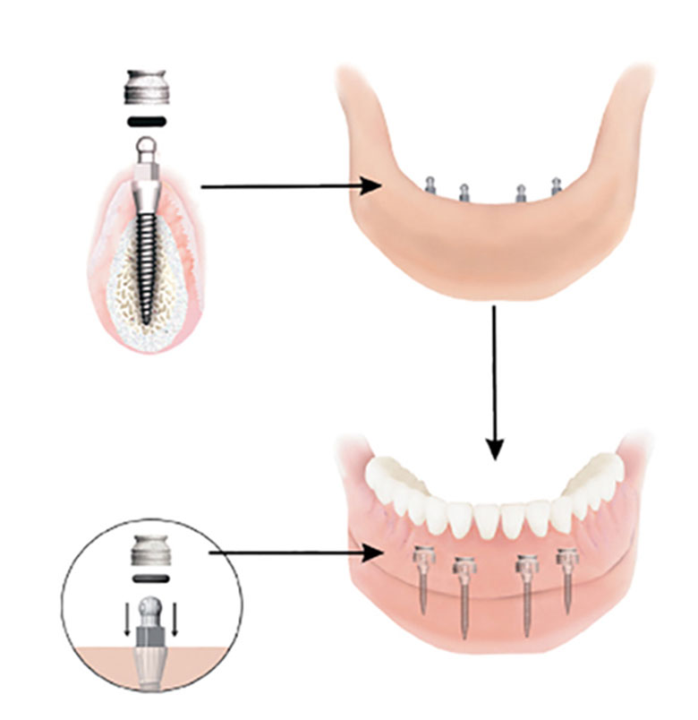 Dental Implant Solutions Buffalo, NY | 33 Melrose Rd suite 1, Buffalo, NY 14221, USA | Phone: (716) 791-9957
