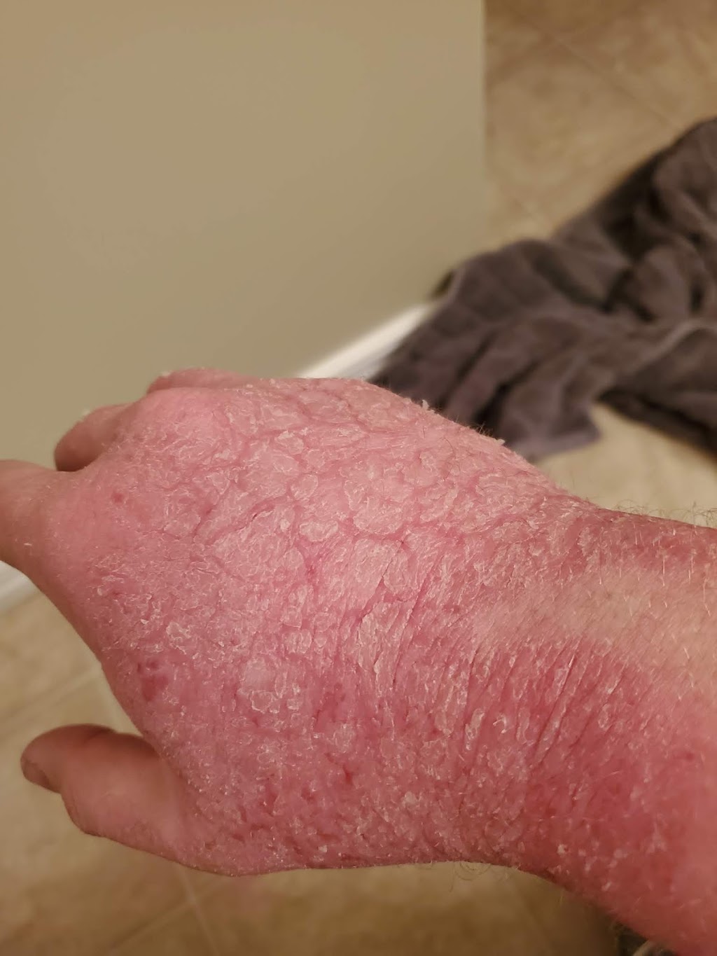 Sideri Allergy Treatment Centre | 7609 109 St NW #305, Edmonton, AB T6G 1C3, Canada | Phone: (780) 893-2018