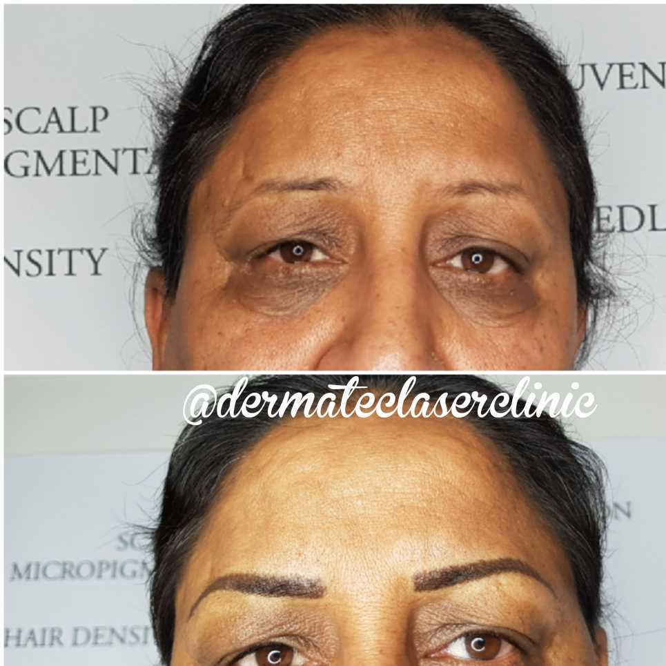 Dermatec Permanent Cosmetic and Laser Clinic | 6499 122a St, Surrey, BC V3W 3R8, Canada | Phone: (604) 805-4273