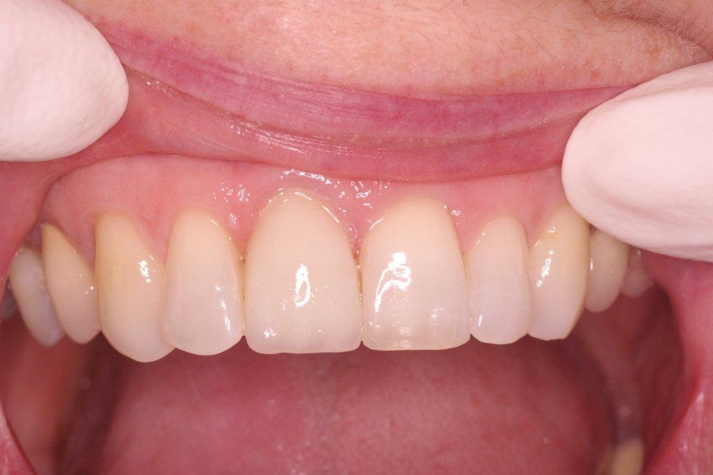 Cad Crowns Ca Inc | 210-1580 Merivale Rd, Nepean, ON K2G 4B5, Canada | Phone: (613) 723-7300