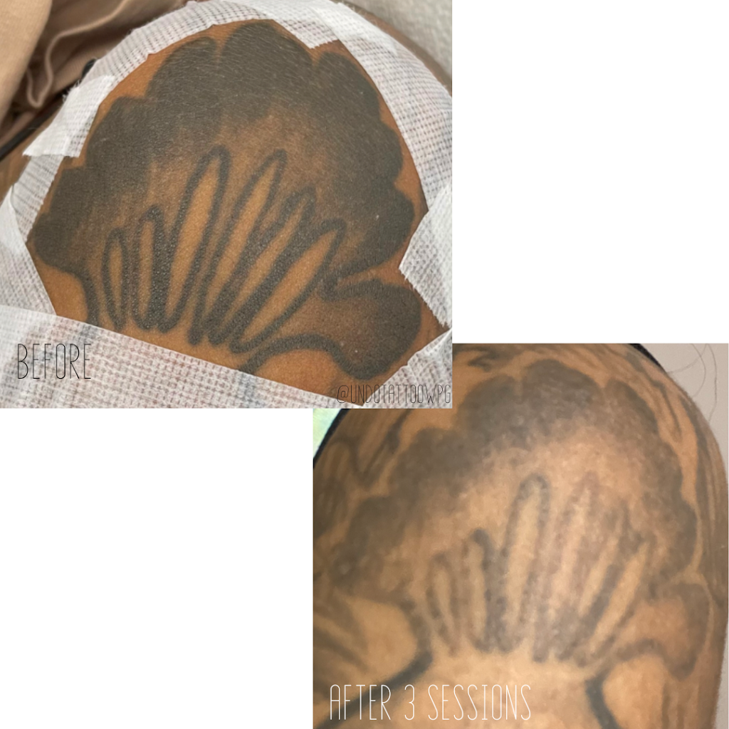 Undo Tattoo Laser Tattoo Removal | 169 Marion St, Winnipeg, MB R2H 0T3, Canada | Phone: (204) 558-8636