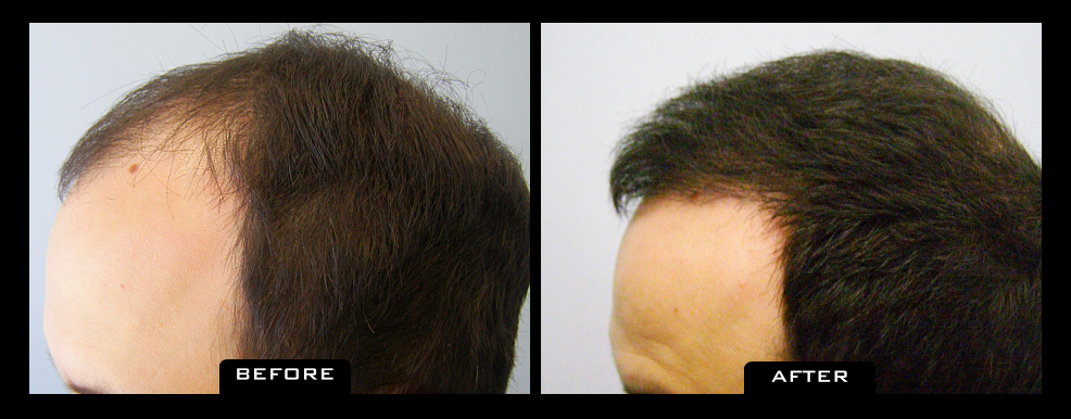 NuHair Medical Hair Transplant Centre | 4040 Veterans Pl NW Unit 200, Calgary, AB T3B 3R7, Canada | Phone: (403) 923-5954