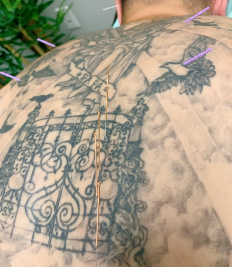 Iron Compass Acupuncture | 12328 102 Ave, Edmonton, AB T5N 0L9, Canada | Phone: (780) 898-0336