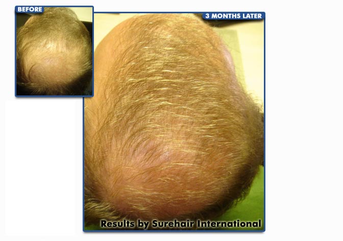 Sure Hair International | 55 Wyndham St N Suite T7, Guelph, ON N1H 7T8, Canada | Phone: (416) 747-7873
